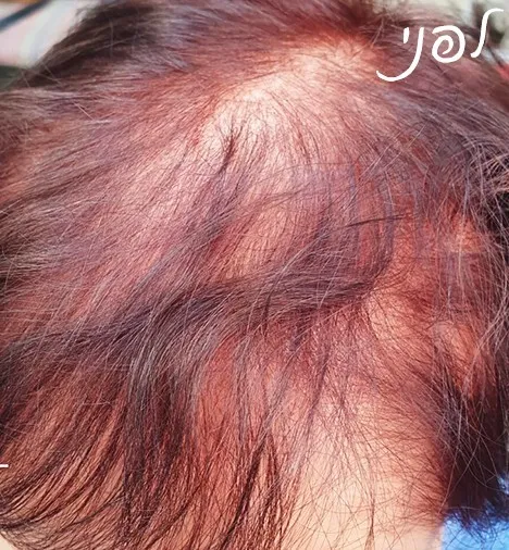 טופרס | אלי כהן אמן הפאות - פתרונות לדלילות שיער