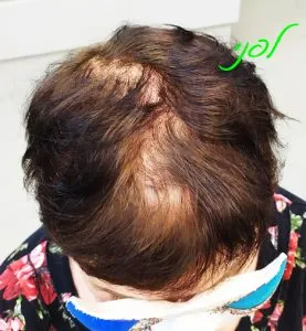 פותחים יום בערוץ 13- דלילות שיער יש פתרון!