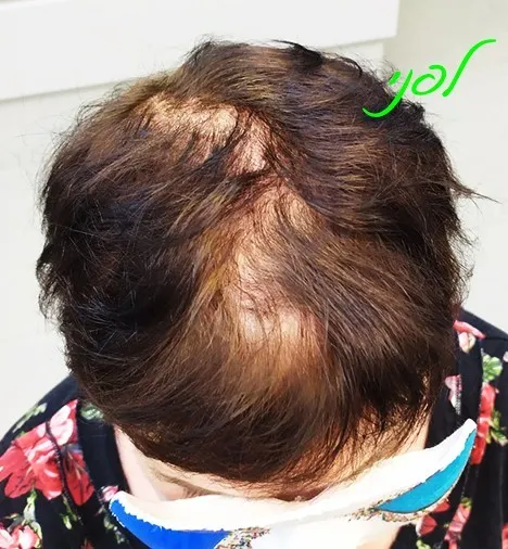 פותחים יום בערוץ 13- דלילות שיער יש פתרון!