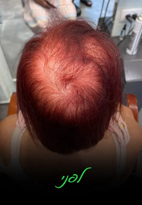 נפח לשיער דליל | אלי כהן - המרכז לפתרונות שיער