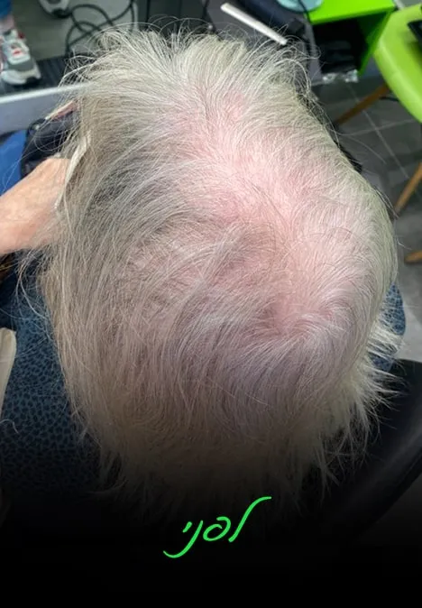 טופרס | אלי כהן - המרכז לפתרונות שיער