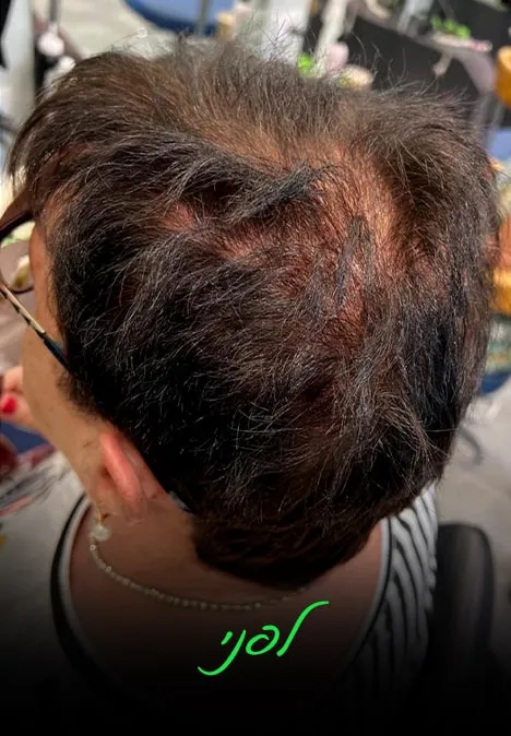 נפח לשיער דליל | אלי כהן - המרכז לפתרונות שיער