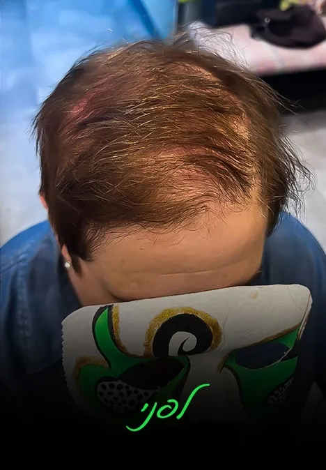 תוספת חלק קדמי | אלי כהן - המרכז לפתרונות שיער