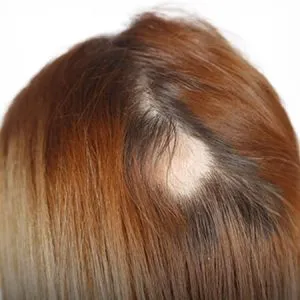 "פותחים יום" ערוץ 13- מגוון הפתרונות להתמודדות עם שיער שנפגע כתוצאה מסטרס