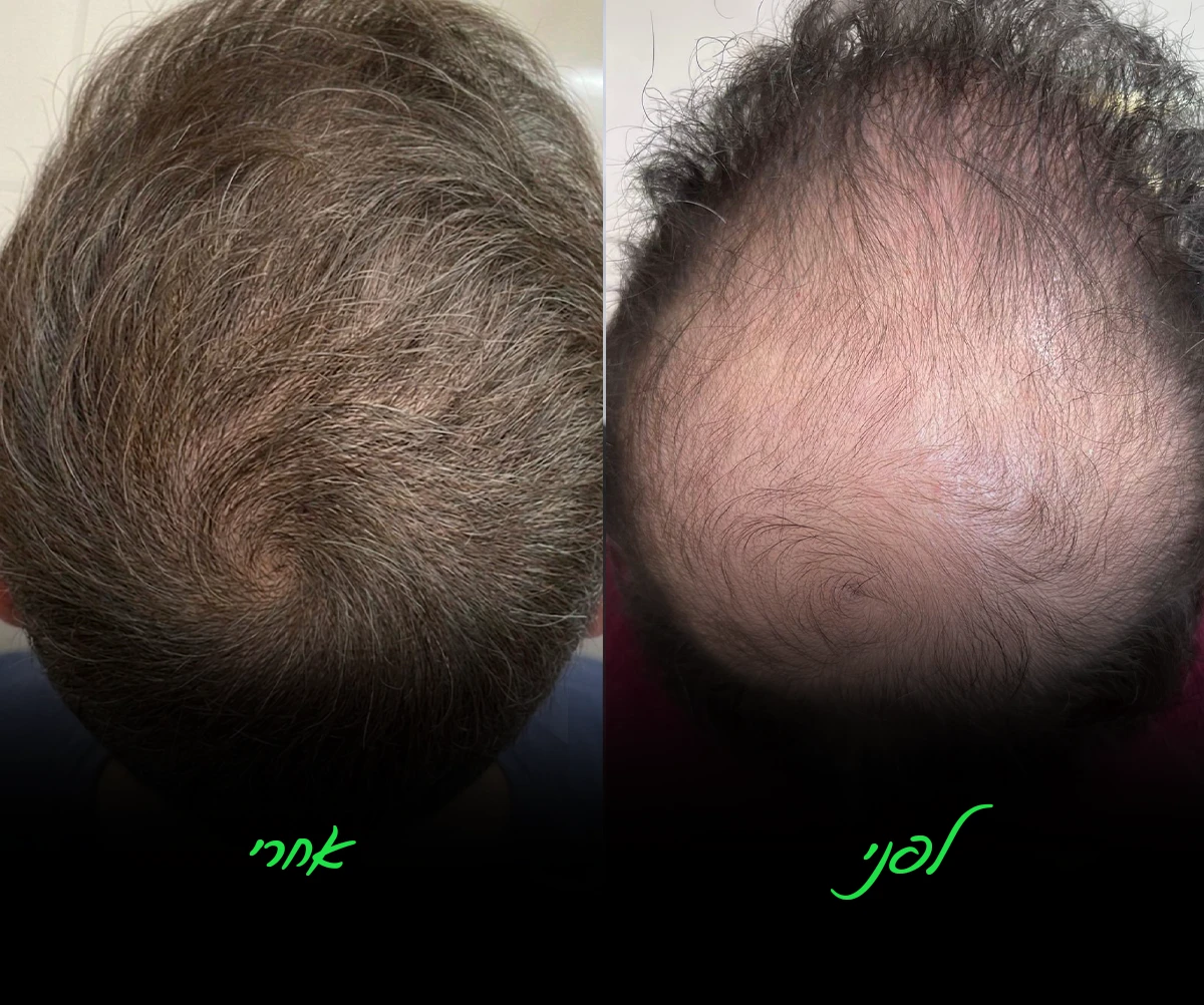 לפני ואחרי — מילוי קרחת בקודקוד