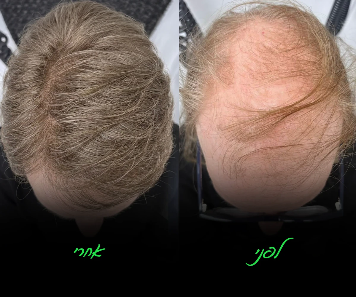 לפני ואחרי — תוספת שיער בחזית הראש