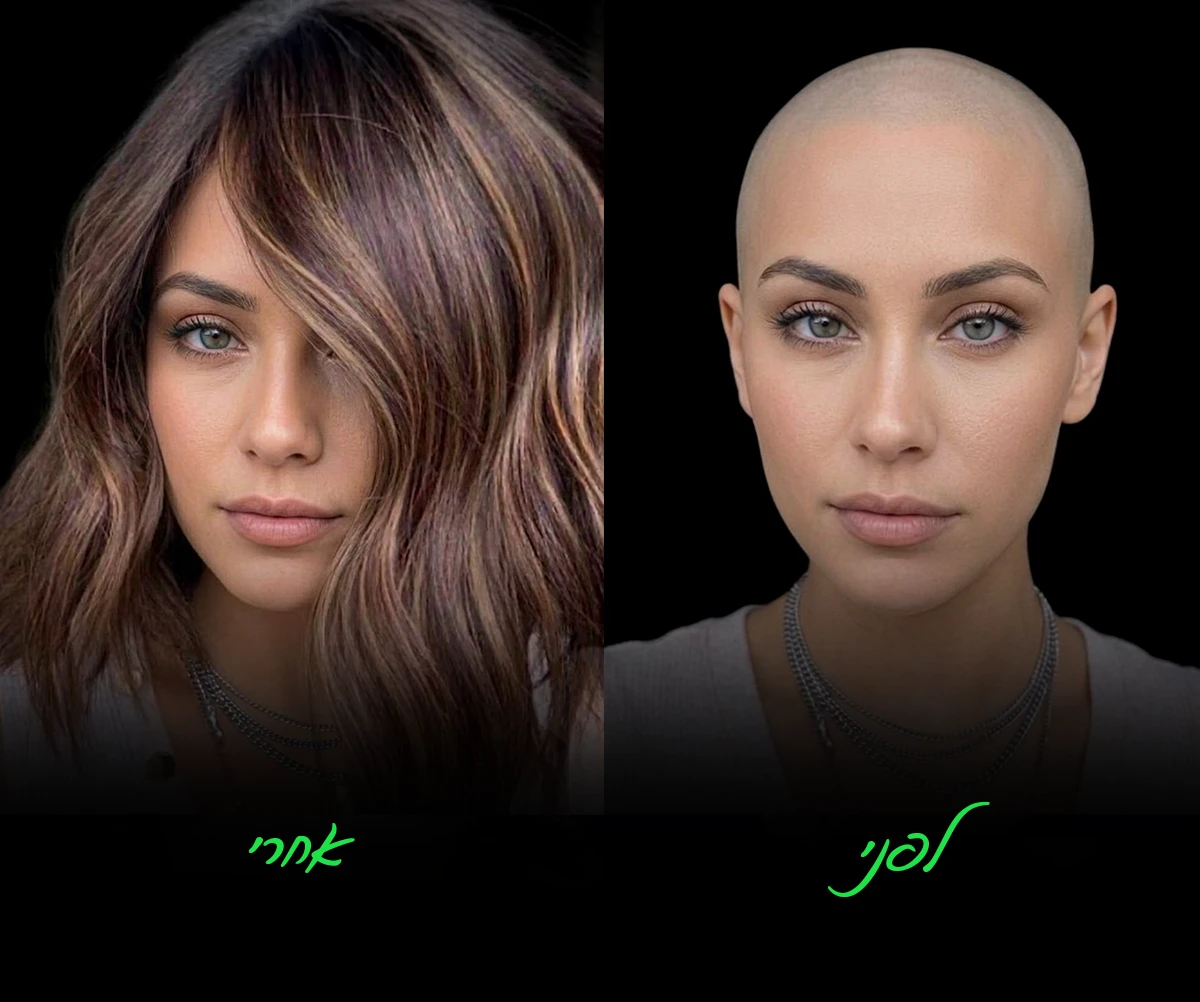 לפני ואחרי — פתרון שיער לאלופציה אראטה